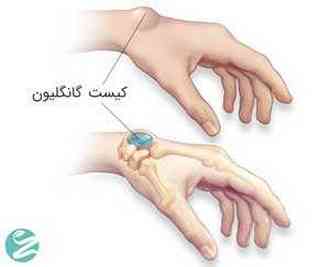 کیست گانگلیون (برآمدگی مچ دست): علل، علائم و روش‌های درمان
