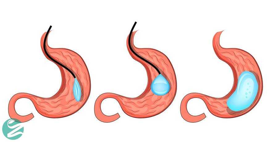 عمل بالون معده