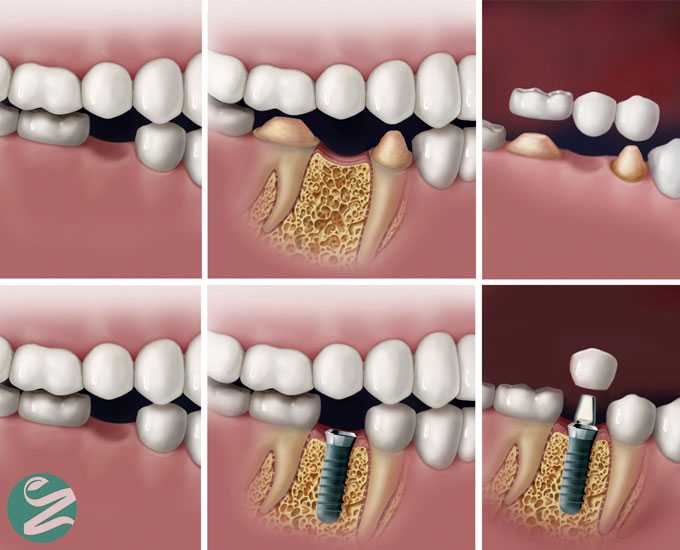 تفاوت های ایمپلنت دندان و بریج دندان