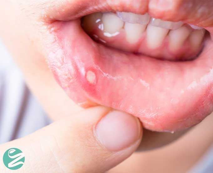 8 درمان ساده و سریع آفت دهان و زبان