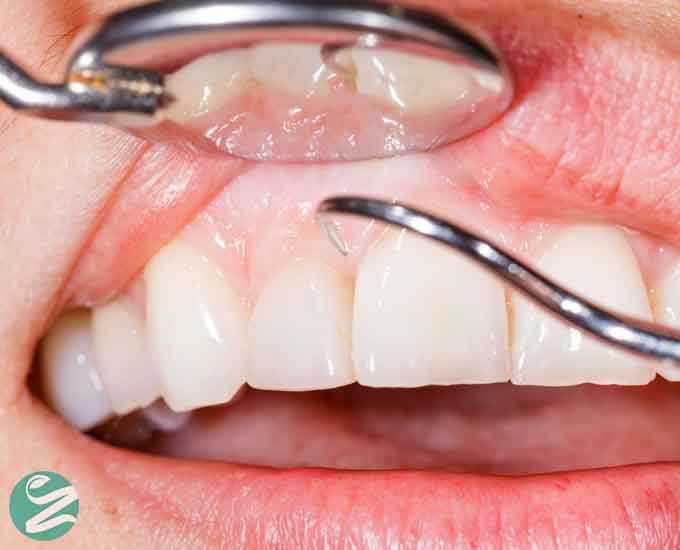 با 16 بیماری شایع و خاص دهان آشنا شوید؛ علائم، علل و روش‌های پیشگیری