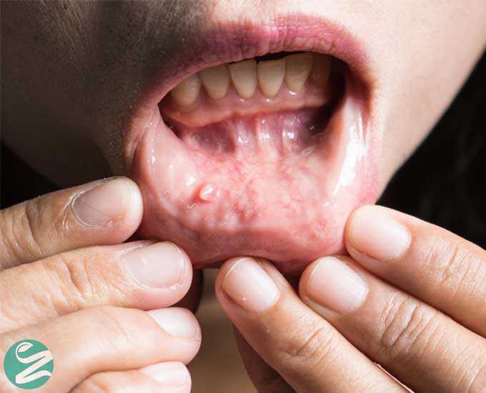 8 نکته برای کاهش خطر ابتلا به سرطان دهان