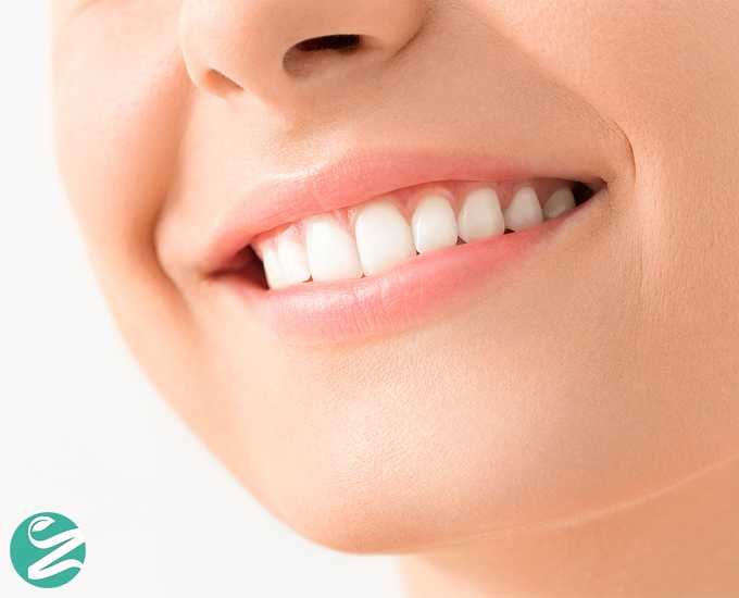 بلیچینگ دندان چیست؟ سفید کردن دندان با این روش خوب است یا بد؟