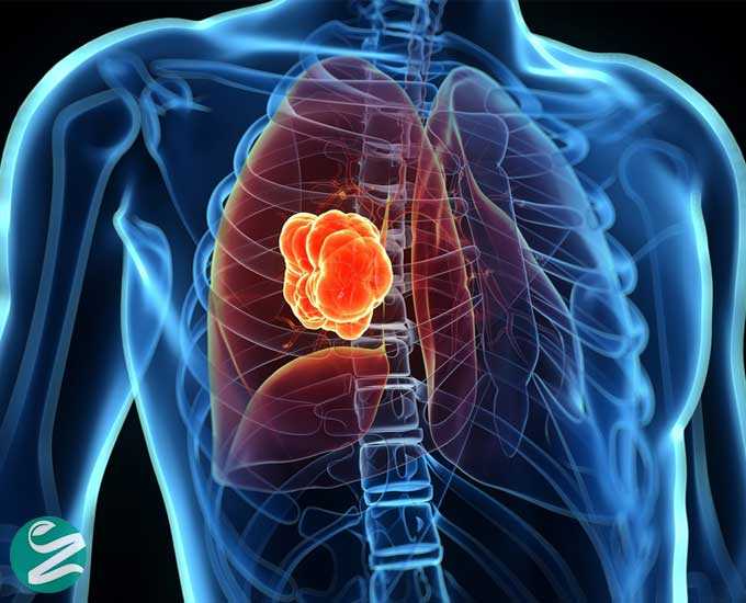 سرطان ریه: علائم، عوامل خطر، روش‌های تشخیص و درمان