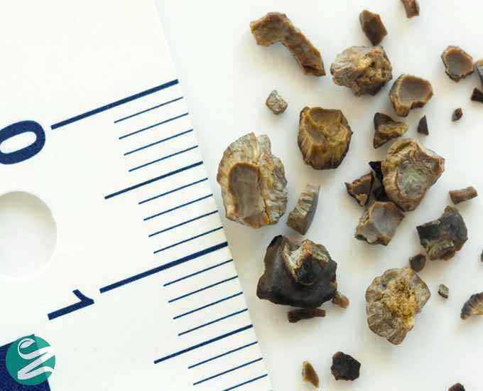 12 راه پیشگیری از ایجاد سنگ کلیه یا تشکیل دوباره سنگ کلیه