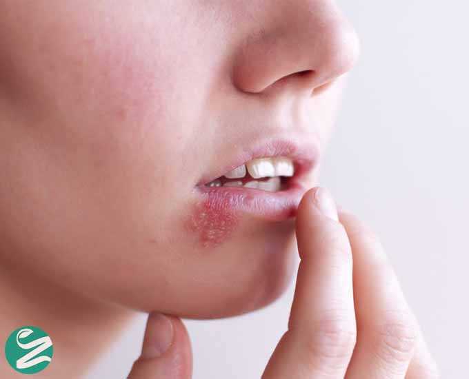 چرا تبخال می‌زنیم؟ مهم‌ترین دلایل ایجاد تبخال