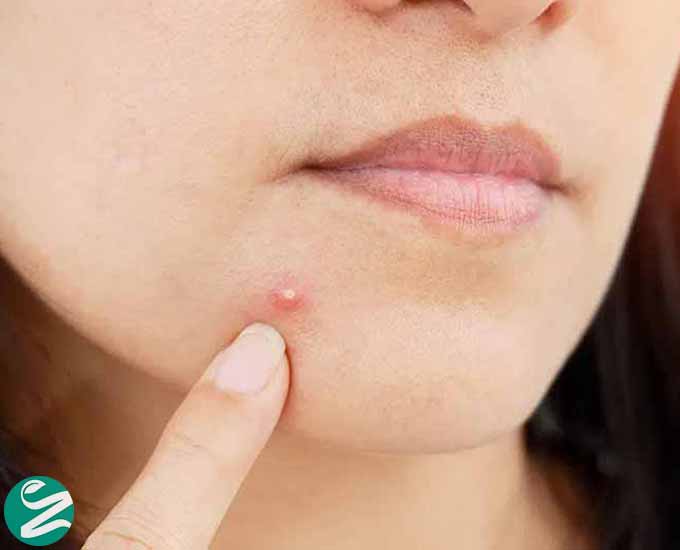 آکنه چیست؟ انواع آکنه، علت و علائم