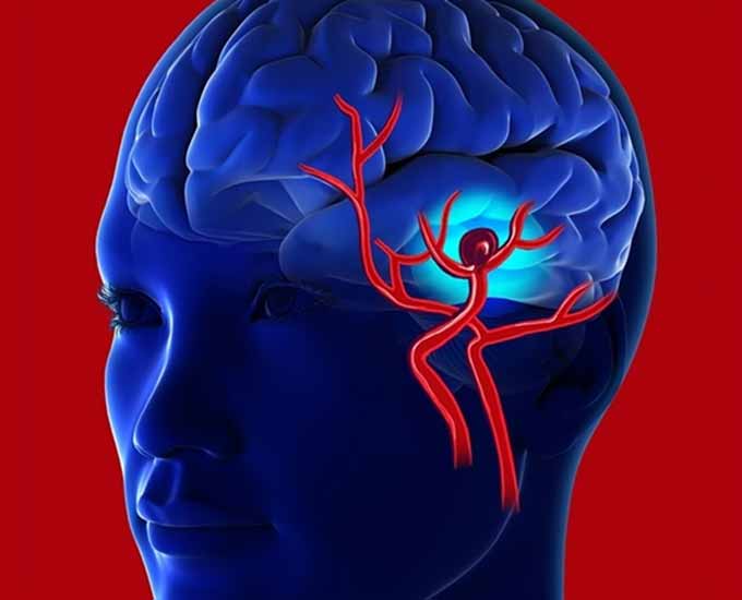 آنوریسم مغزی چه بیماری است؟
