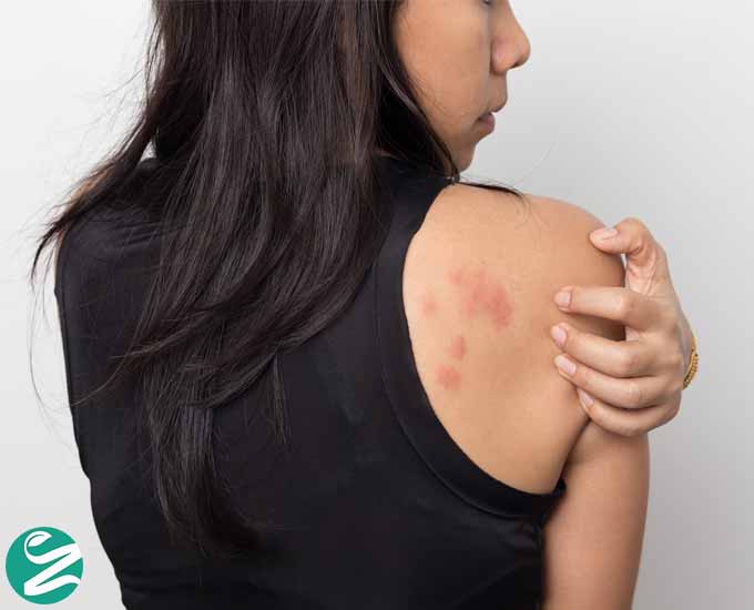 19 درمان خانگی عفونت های پوستی