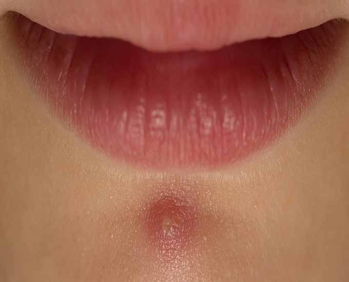 از بین بردن جوش زیر پوستی با 10 روش خانگی