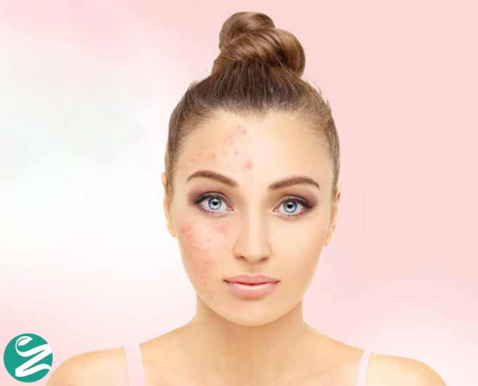 بهترین روش‌های جلوگیری از باز شدن منافذ پوست