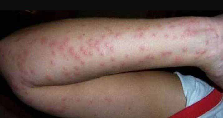 گزیدگی حشره ساس