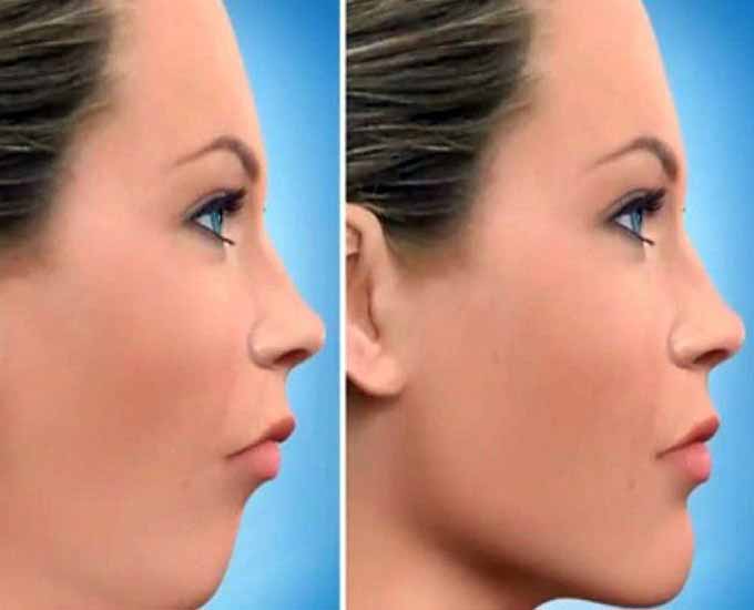 تاثیرات جراحی فک بر زیبایی صورت