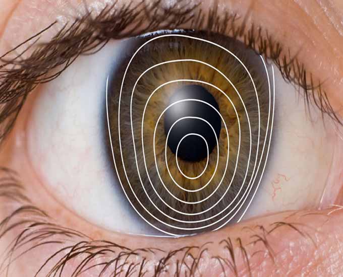 آشنایی با بیماری‌ چشمی قوز قرنیه