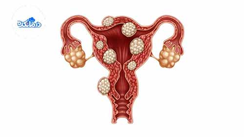 تصویر فیبروم رحم را به صورت گرافیکی نشان میدهد. فیبرومها به شکل تودههای سفید رنگ در قسمتهای مختلف رحم قرار گرفتهاند. تصویر فیبروم رحم را به صورت گرافیکی نشان میدهد. فیبرومها به شکل تودههای سفید رنگ در قسمتهای مختلف رحم قرار گرفتهاند.