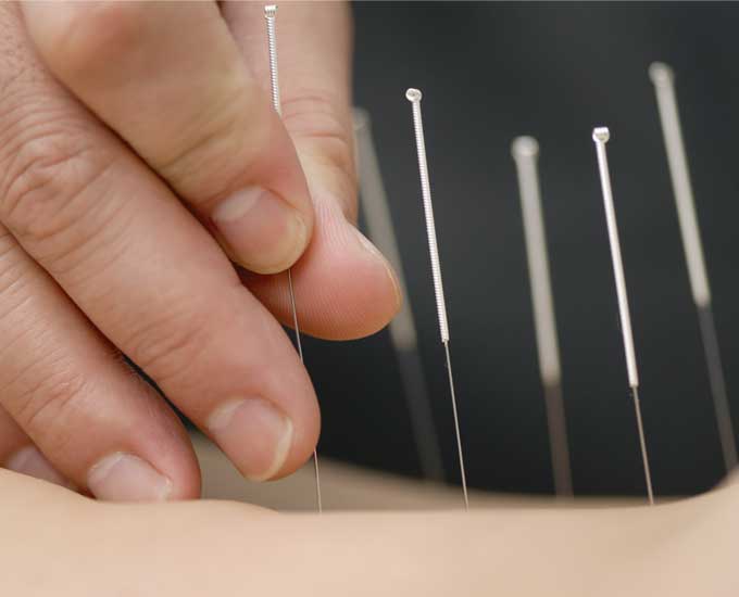 درمان بیماری‌ها با طب سوزنی ممکن است؟