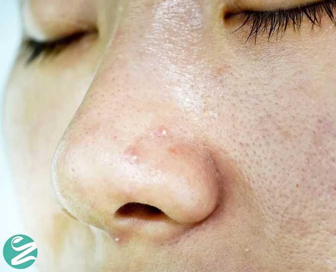 بهترین روش‌های خانگی درمان جوش سر سفید