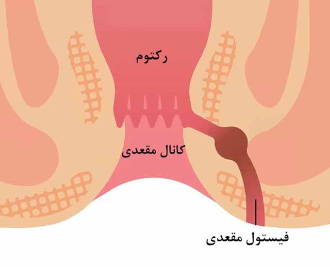 10 راهکار موثر برای کاهش درد فیستول مقعدی