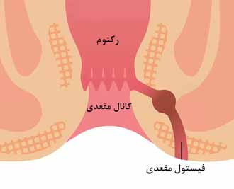 10 راهکار موثر برای کاهش درد فیستول مقعدی