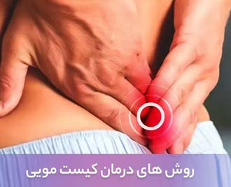 روش های درمان کیست مویی