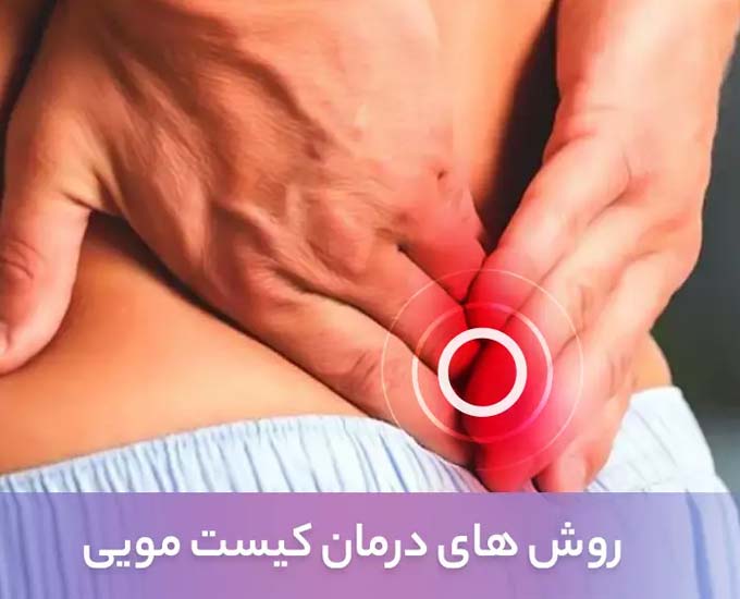 روش های درمان کیست مویی