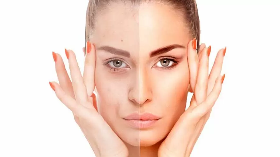 چرا در دوران بارداری جوش میزنیم؟ دلایل + راه های جلوگیری