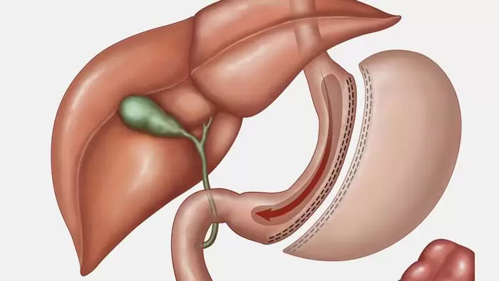 مزیت های عمل اسلیو معده