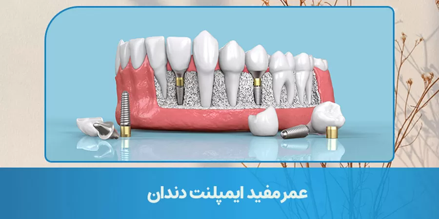 عمر مفید ایمپلنت دندان چقدر است؟