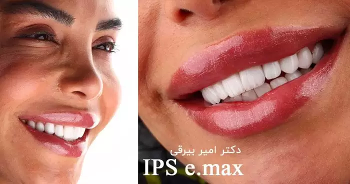 لمینت دندان و زیبایی صورت