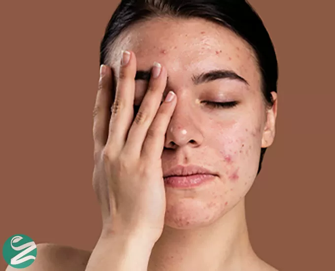 چند نوع حساسیت پوستی داریم؟ معرفی انواع، علت، علائم و درمان