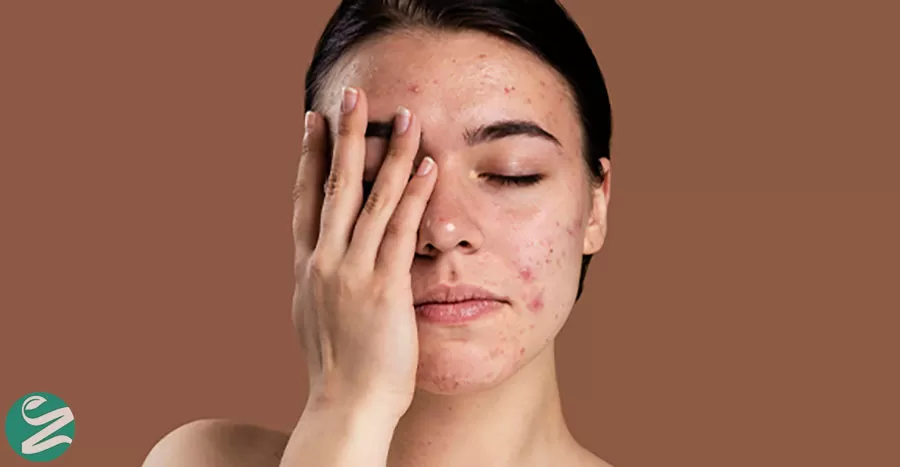 چند نوع حساسیت پوستی داریم؟ معرفی انواع، علت، علائم و درمان