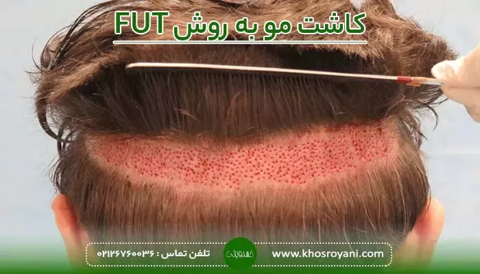 روش های کاشت مو