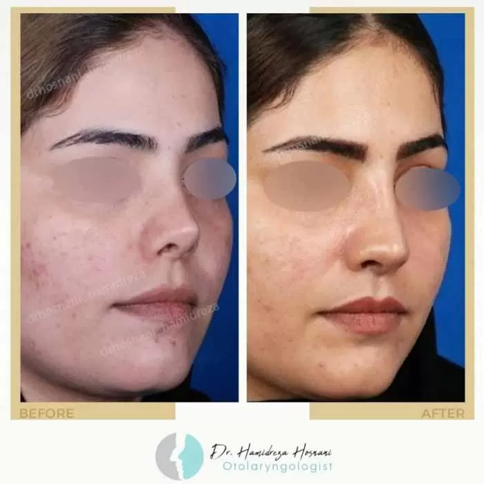 عوامل موثر بر سختی عمل بینی ثانویه یا ترمیمی