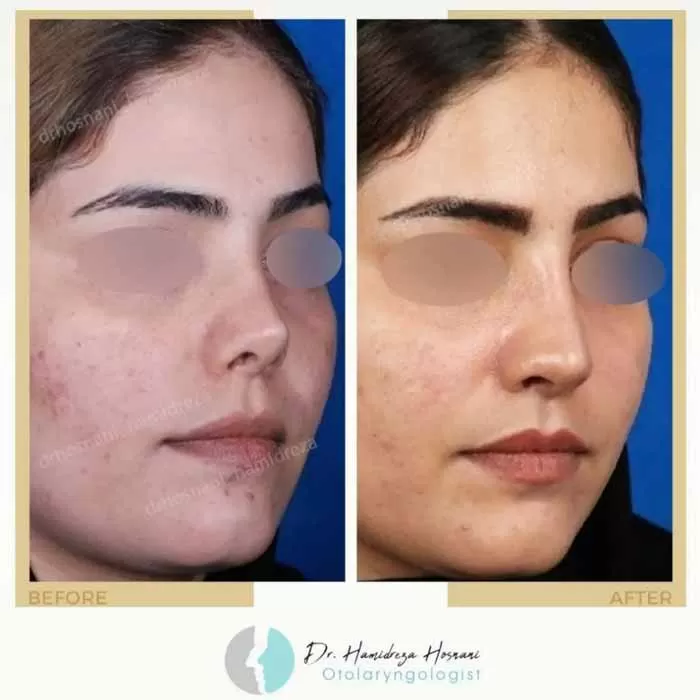 نتیجه عمل بینی ثانویه یا ترمیمی