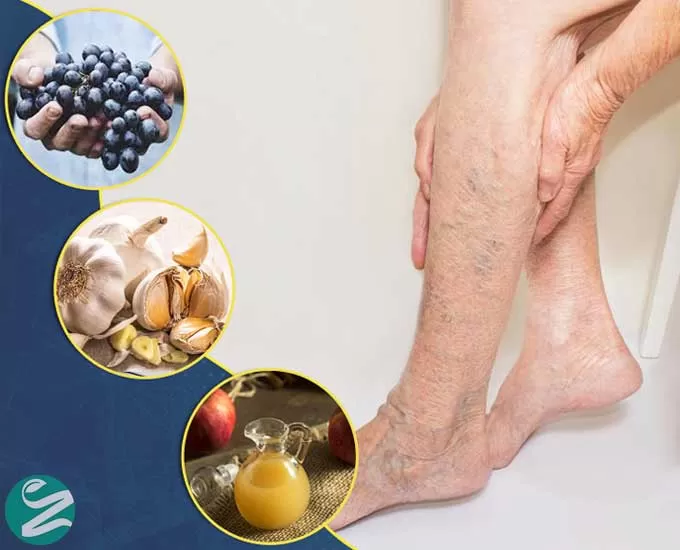13 درمان خانگی و گیاهی واریس پا
