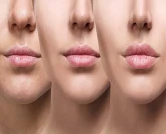 روش‌های مراقبت از فیلر لب برای ماندگاری بیشتر