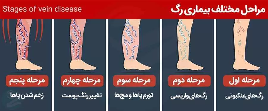 مراحل ایجاد واریس پا