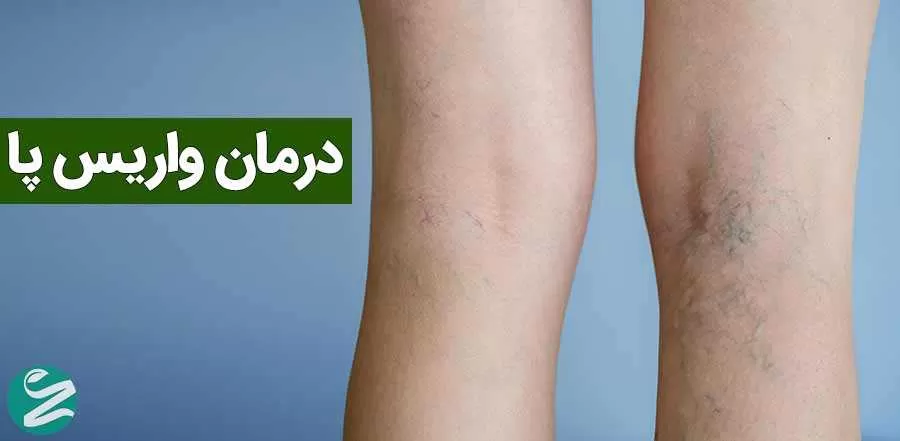 روشهای درمان واریس پا
