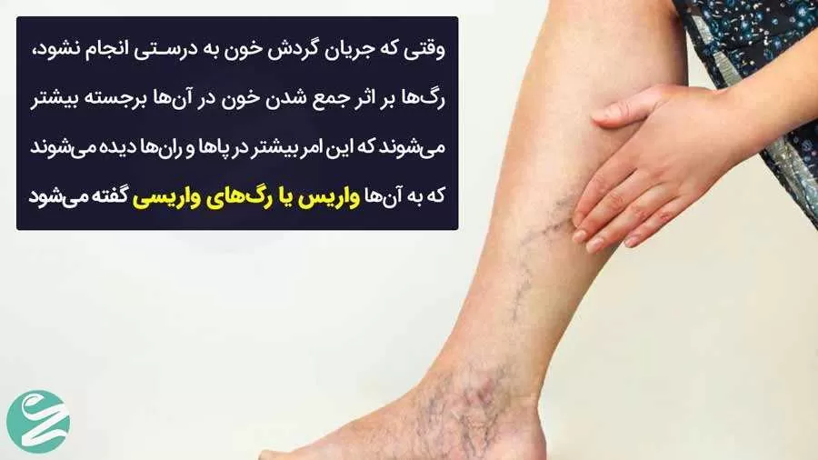 علائم واریس پا چیست؟