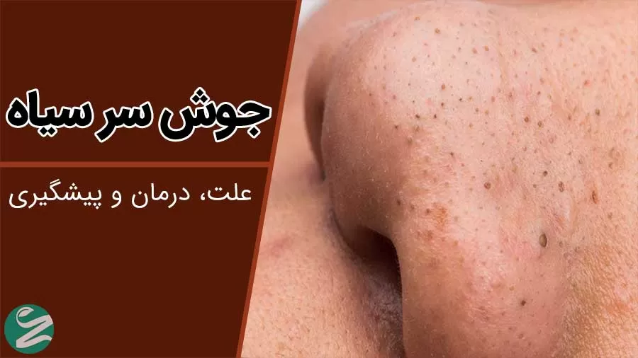 جوش‌ های سرسیاه زیر پوستی؛ از علت تا درمان جوش سر سیاه