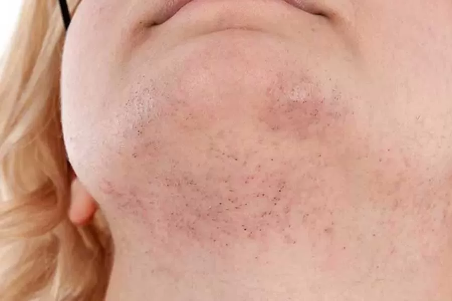 علت موهای زیر چانه چیست؟ بررسی علل + روش های رفع