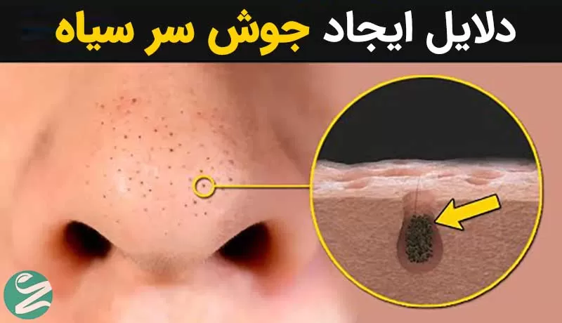 علت جوش سر سیاه