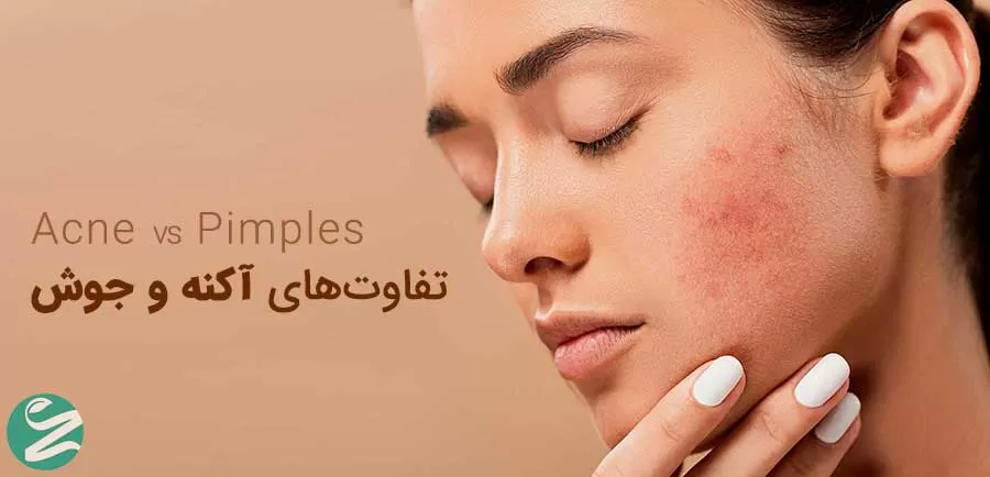 جوش و آکنه چه تفاوتی با هم دارند؟ بررسی تفاوت‌ها از علت تا درمان