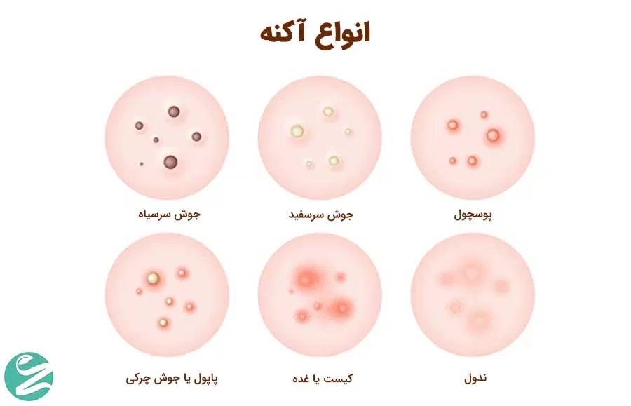 انواع آکنه و علائم آنها