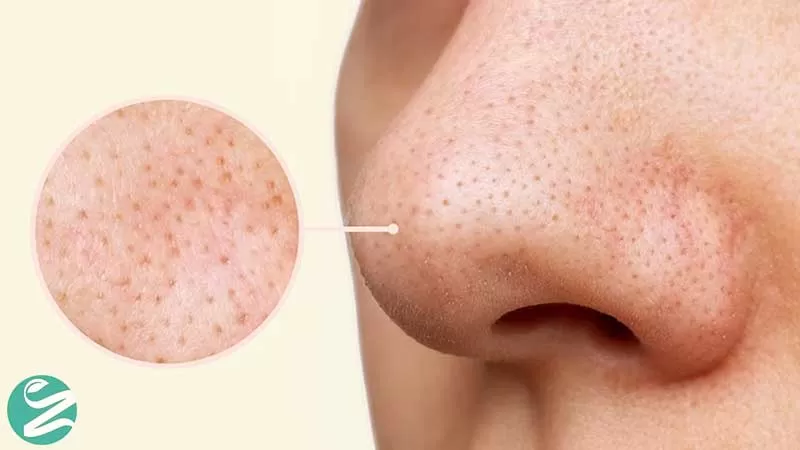 جوش سر سیاه چیست؟