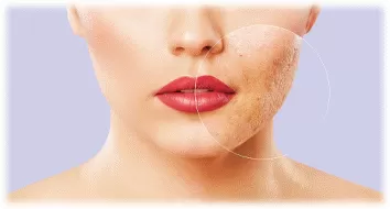 لیزر آکنه راه‌حلی نوین و امیدوارکننده برای بازیابی سلامتی و زیبایی است.