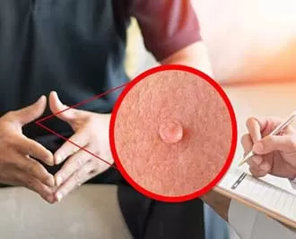 راههای درمان زگیل تناسلی (hpv)