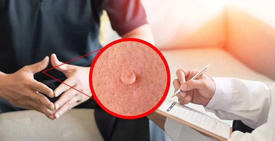 راه‌های درمان زگیل تناسلی (hpv)