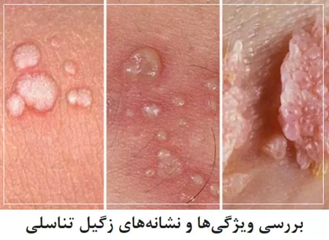 نشانه زگیل تناسلی