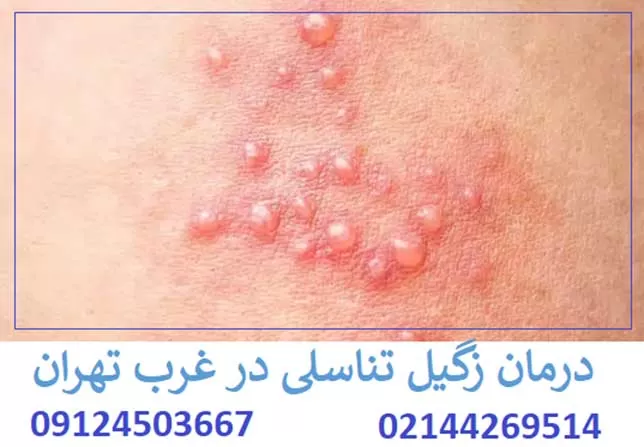 مرکز درمان زگیل تناسلی در غرب تهران